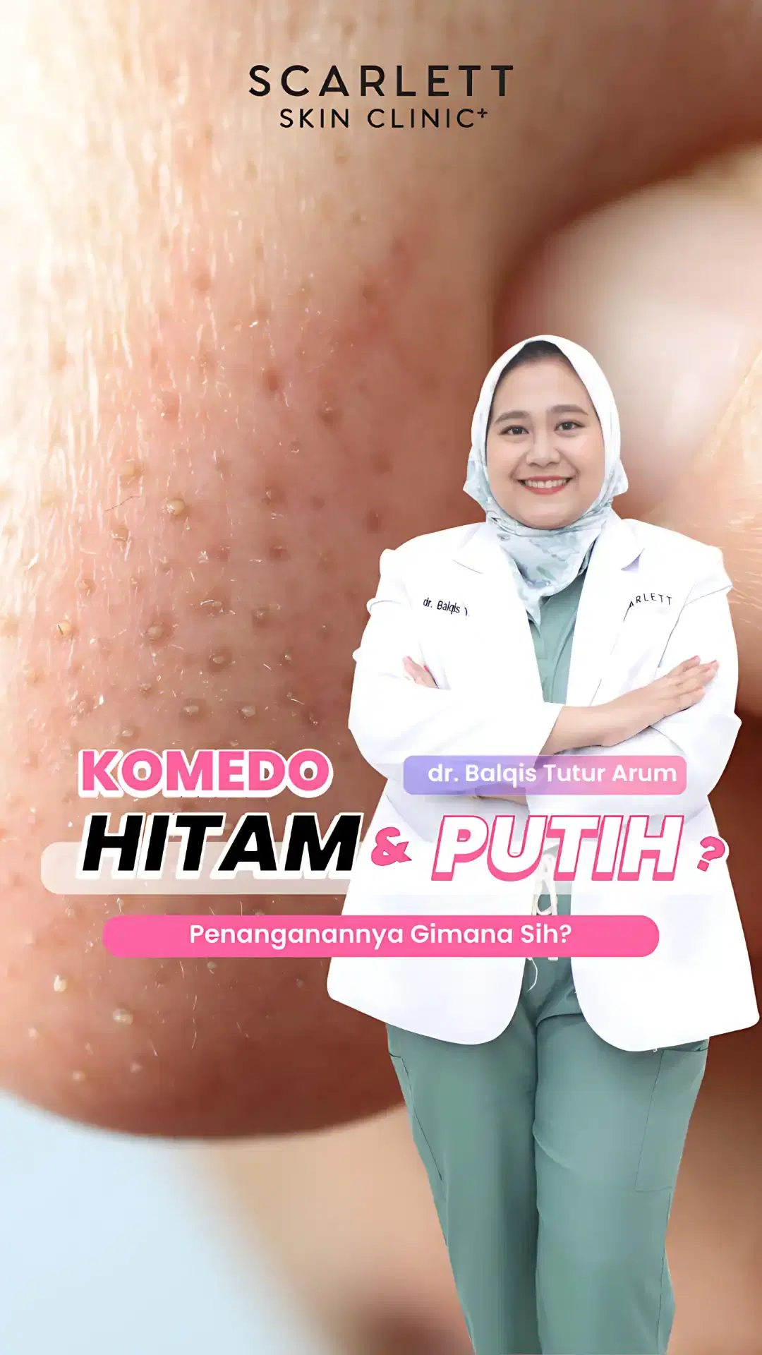 Komedo Hitam dan Putih