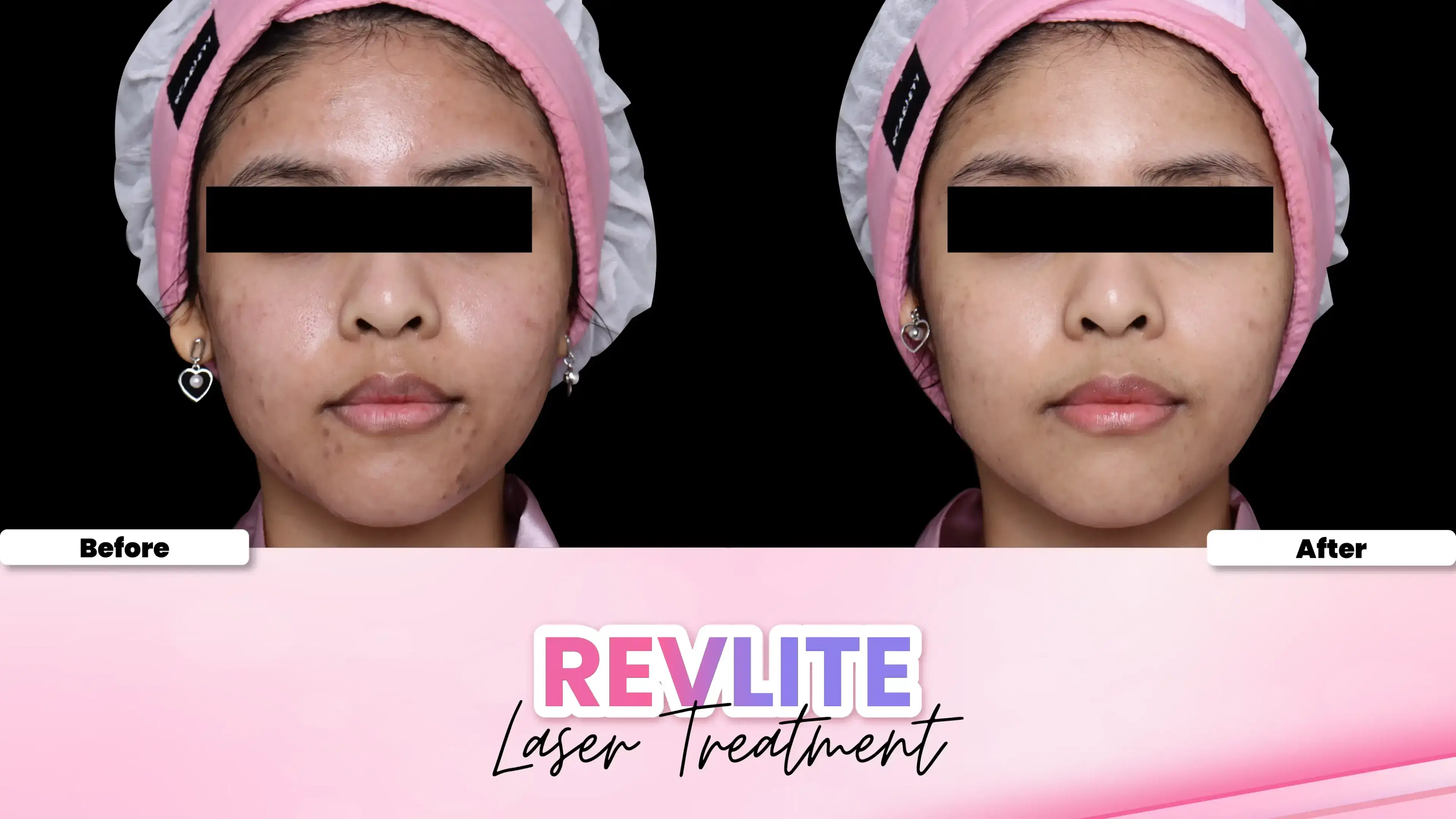Face Rejuvenation Revlite Laser treatment
