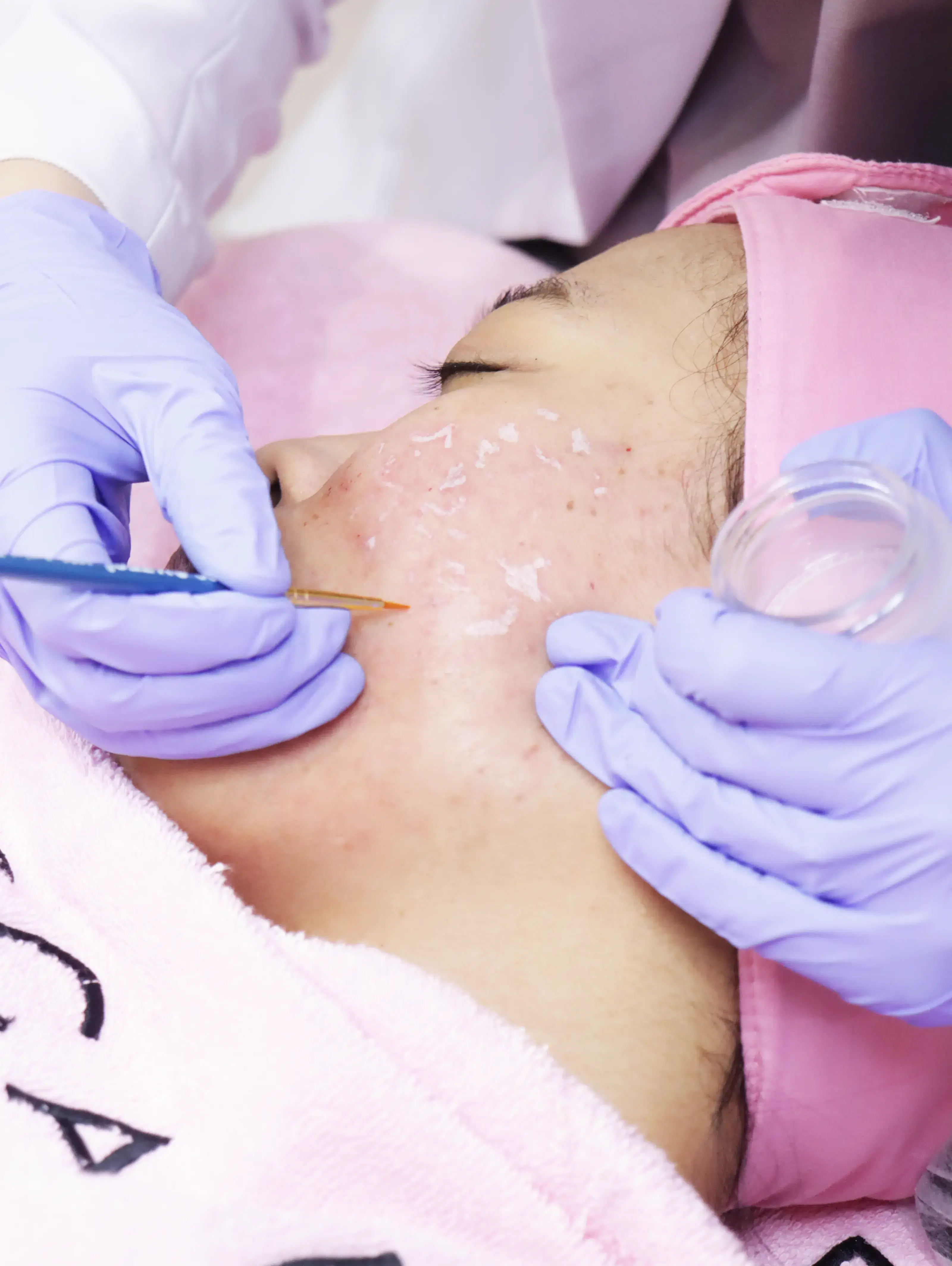 Scars Peeling treatment