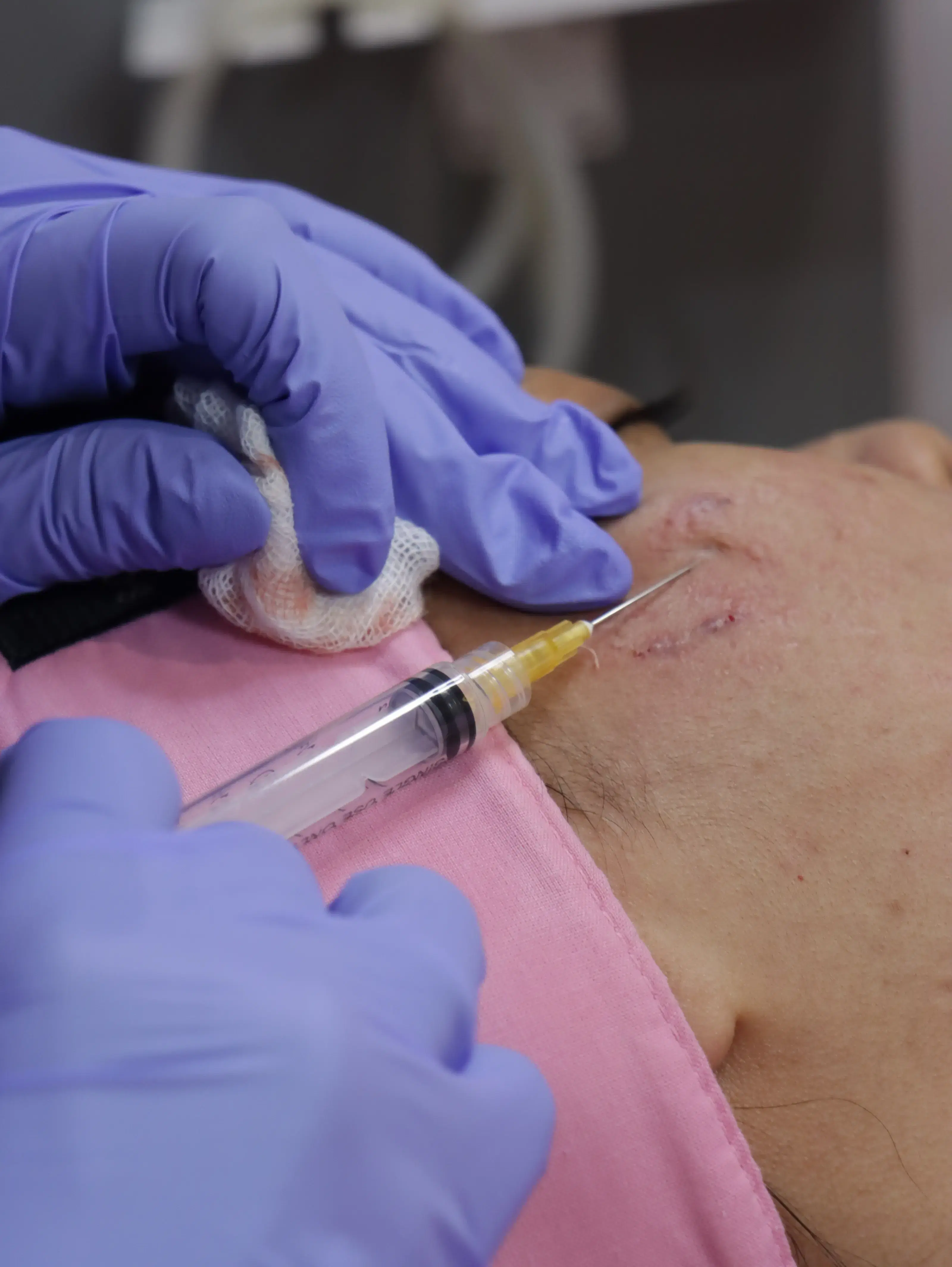 Subcision Treatment treatment