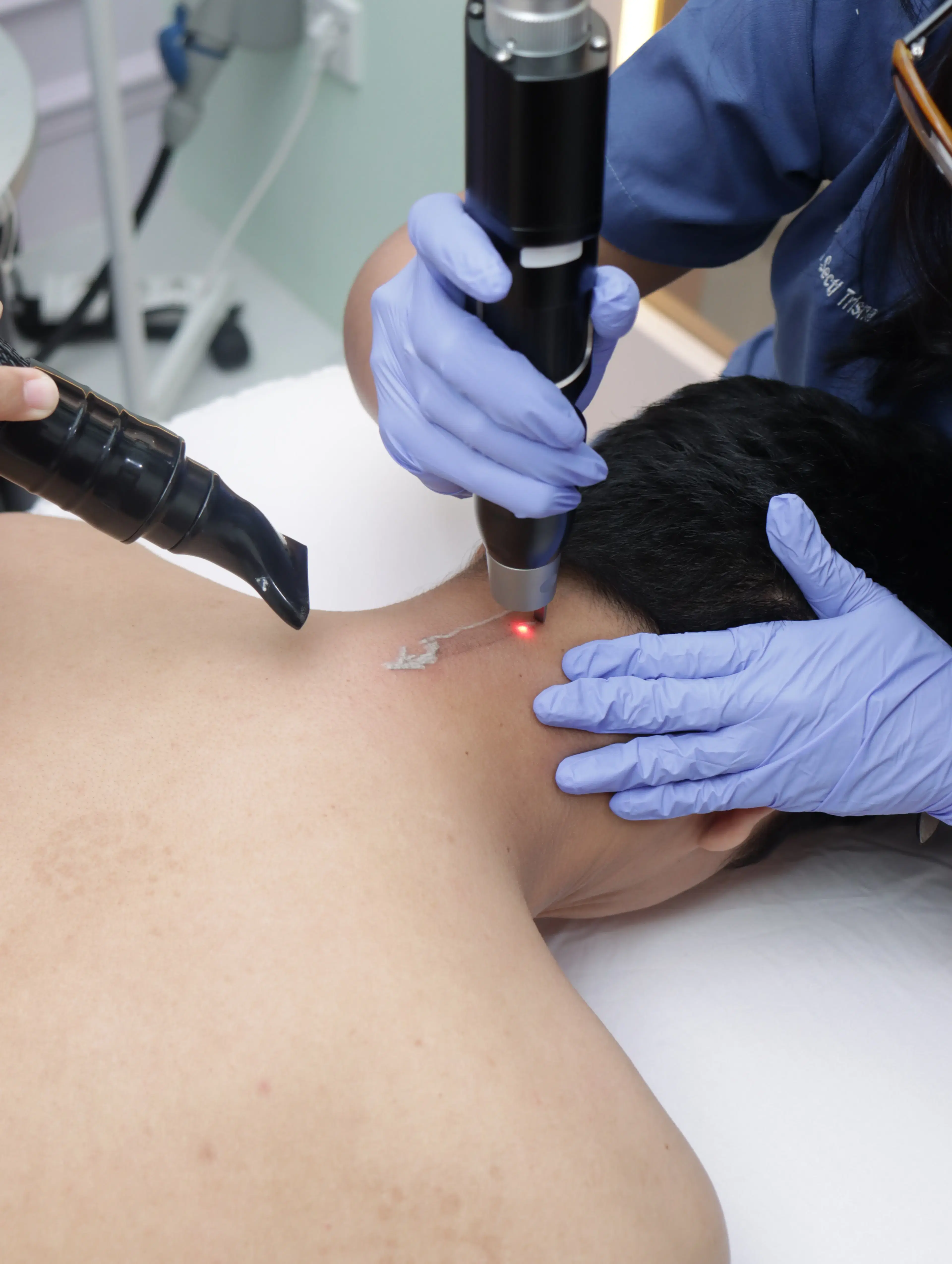 Tattoo/Nevus Picosure Laser treatment