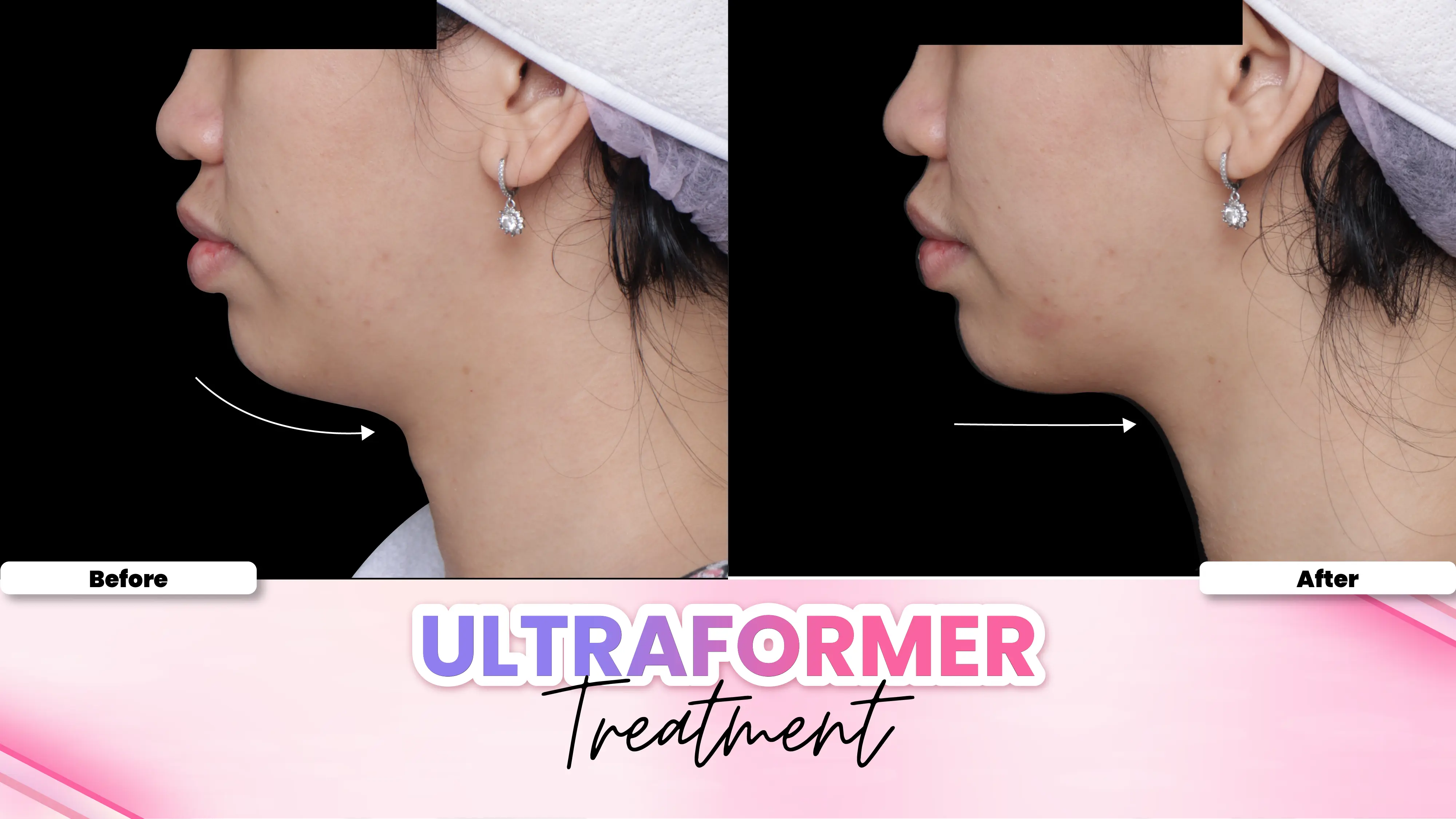 Before after treatment