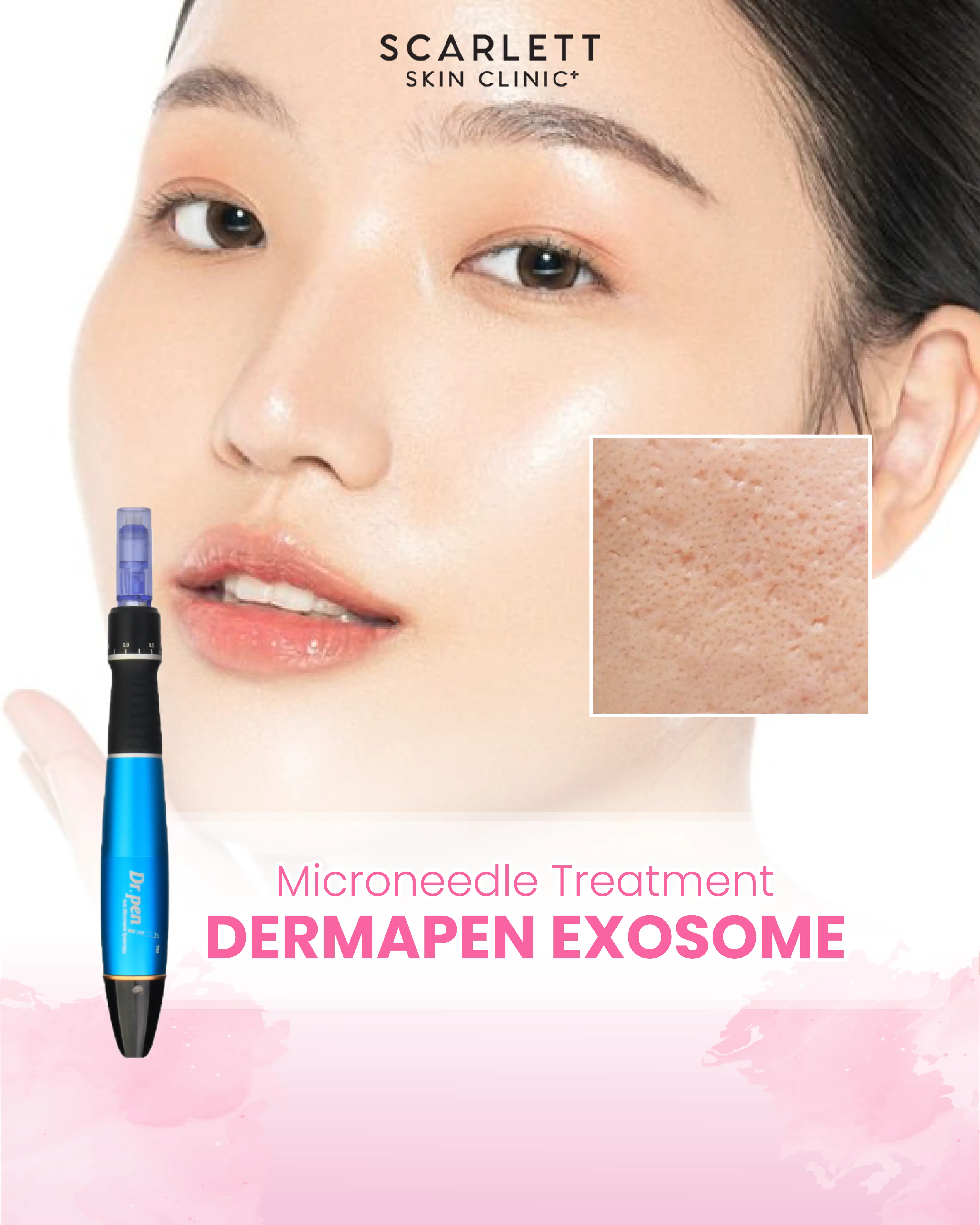 Dermapen Exosome Treatment